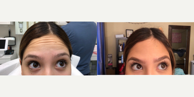 Botox before and after photo