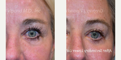 Eyelid Surgery before and after photo