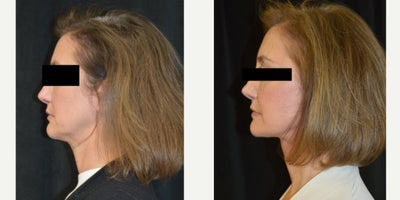 Facelift before and after photo