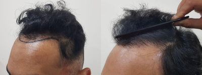 FUE Hair Transplant before and after photo