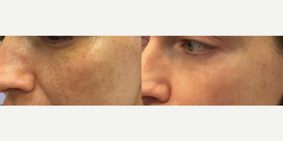 IPL before and after photo