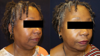 Kybella before and after photo
