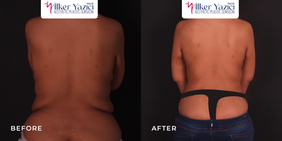 Mommy Makeover before and after photo