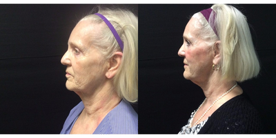 Ultherapy before and after photo