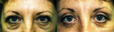 Eyelid Surgery before and after photo