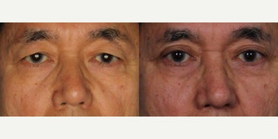 Eyelid Surgery before and after photo