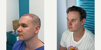 FUE Hair Transplant before and after photo