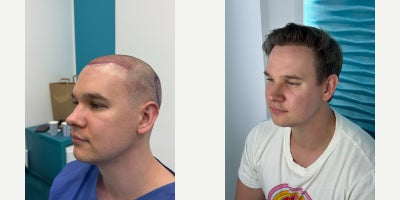 FUE Hair Transplant before and after photo