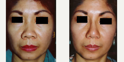 Asian Rhinoplasty before and after photo