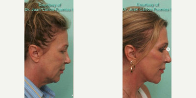 Facelift before and after photo
