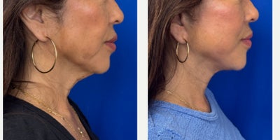 Facelift before and after photo