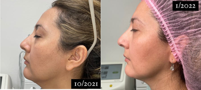 IPL before and after photo