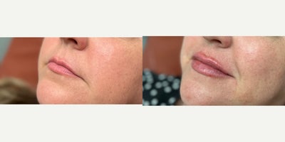 Lip Fillers before and after photo