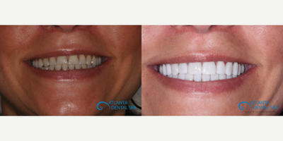 Porcelain Veneers before and after photo