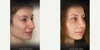 Rhinoplasty before and after photo