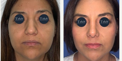 Rhinoplasty before and after photo
