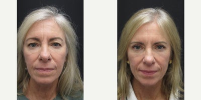 Eyelid Surgery before and after photo