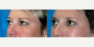 Eyelid Surgery before and after photo