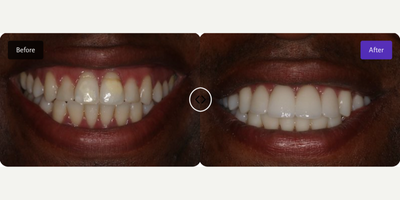 Gum Lift before and after photo