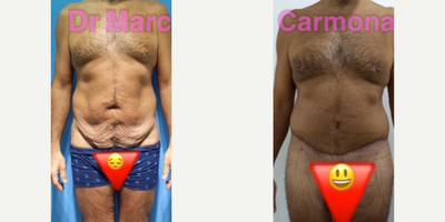 Tummy Tuck before and after photo