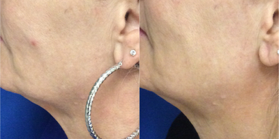 Chemical Peel before and after photo