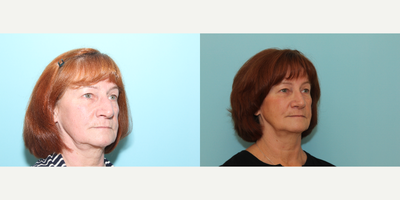 Rhinoplasty before and after photo