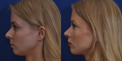 Rhinoplasty before and after photo