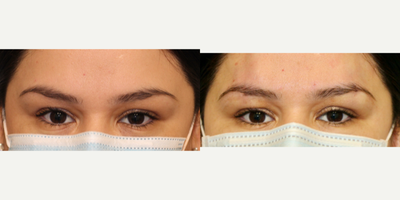 Skin Rejuvenation before and after photo