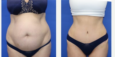 Tummy Tuck before and after photo
