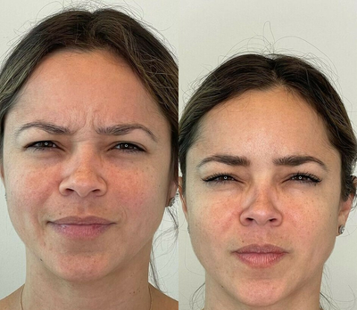 Botox before and after photo