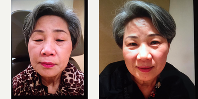 Double Eyelid Surgery before and after photo