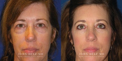 Eyelid Surgery before and after photo