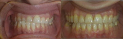 Invisalign before and after photo
