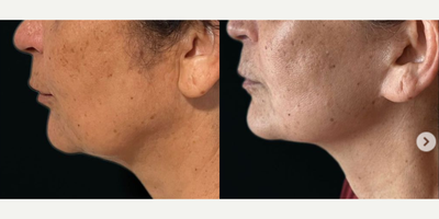 Mini Facelift before and after photo