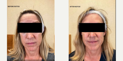 Botox before and after photo