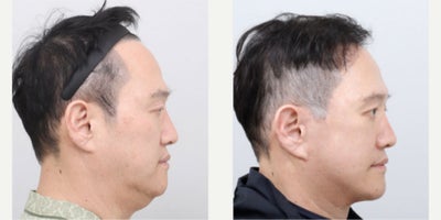 Brow Lift before and after photo