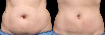 CoolSculpting before and after photo