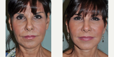 Facelift before and after photo