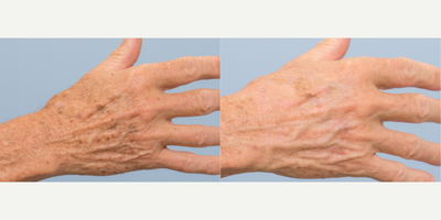 IPL before and after photo
