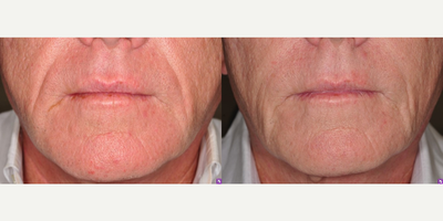 Radiesse before and after photo