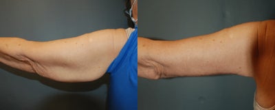 Arm Lift before and after photo