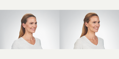 Botox before and after photo