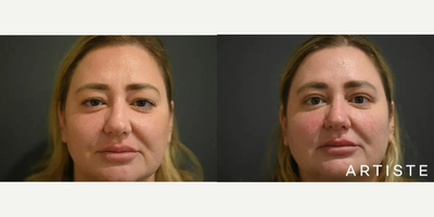 Eyelid Surgery before and after photo