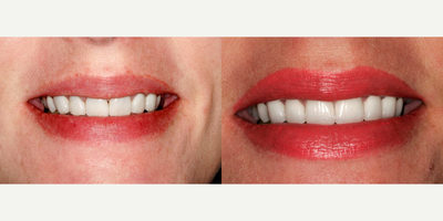 Porcelain Veneers before and after photo