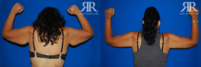 Arm Lift before and after photo