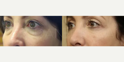 Eyelid Surgery before and after photo