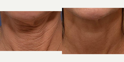 Profound RF before and after photo