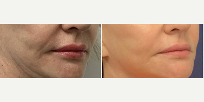Restylane Kysse before and after photo