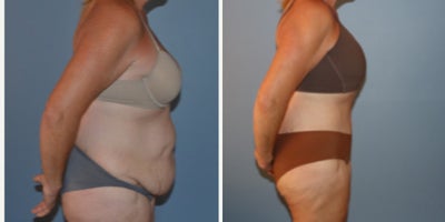 Tummy Tuck before and after photo