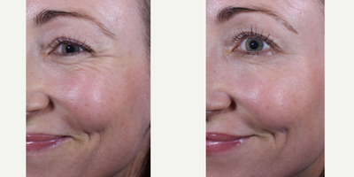 Botox before and after photo